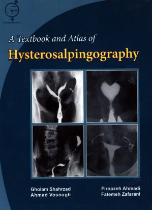 hysterosalpingography-299x412 (1).jpg